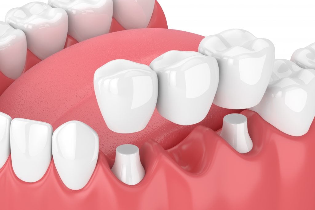 3d render of jaw with dental bridge  over white background