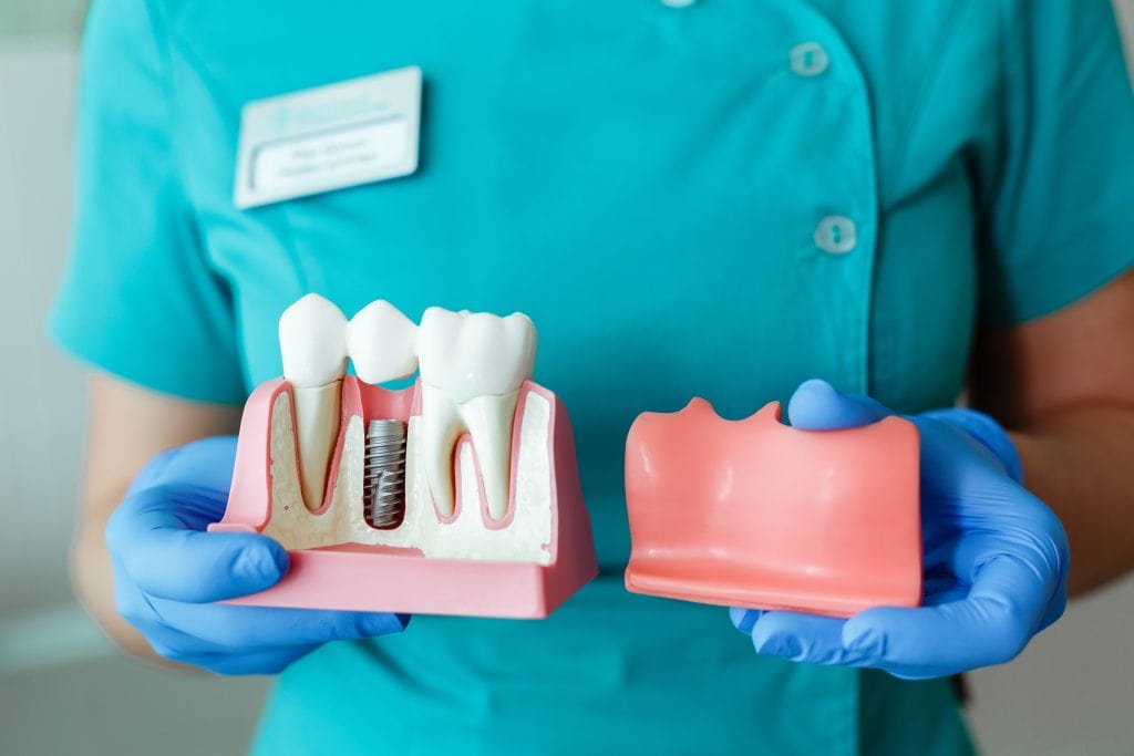 hands of the dentist hold a breadboard model of the tooth with an implant