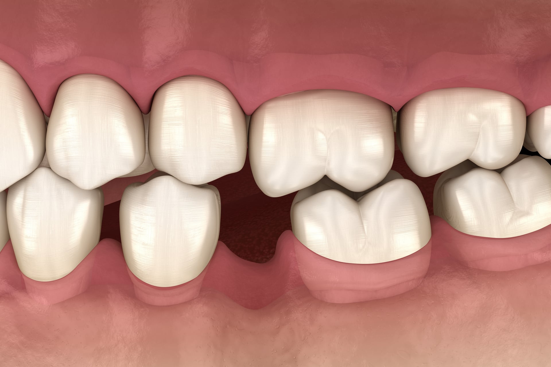 Деформация зубов после выпадения